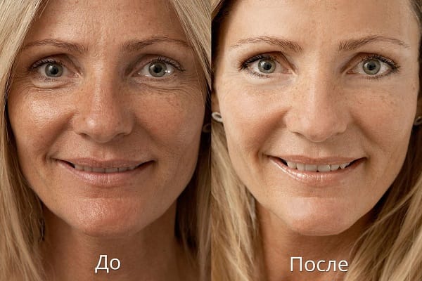 Эффект от биоревитализации