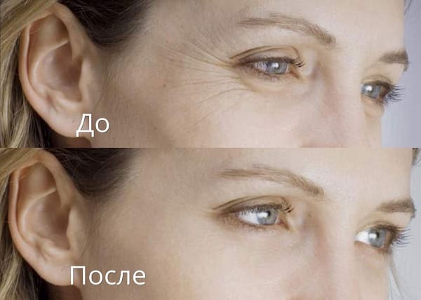 Коррекция периорбитальной зоны