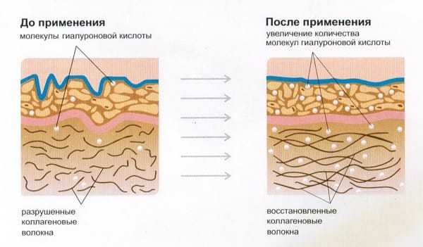 Схема воздействия гиалуроновой кислоты