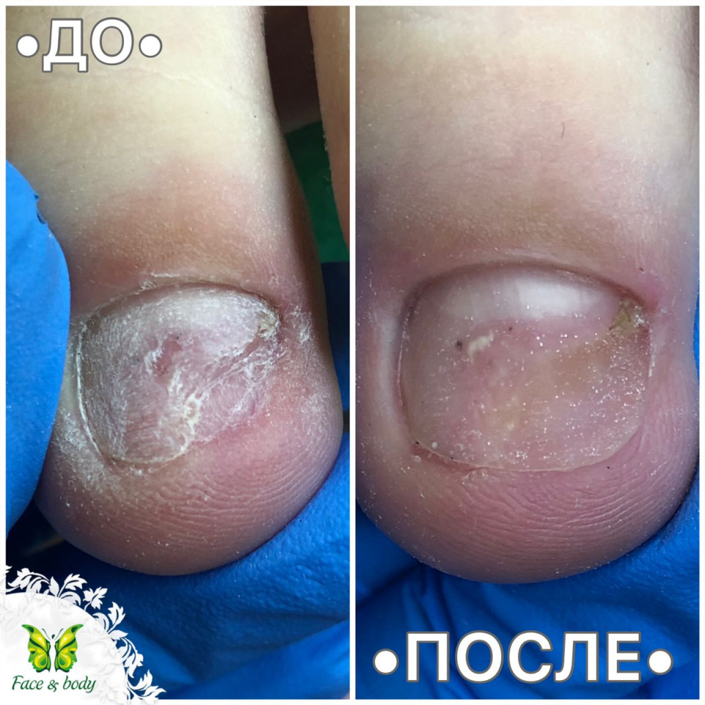 Онихолизис.jpg