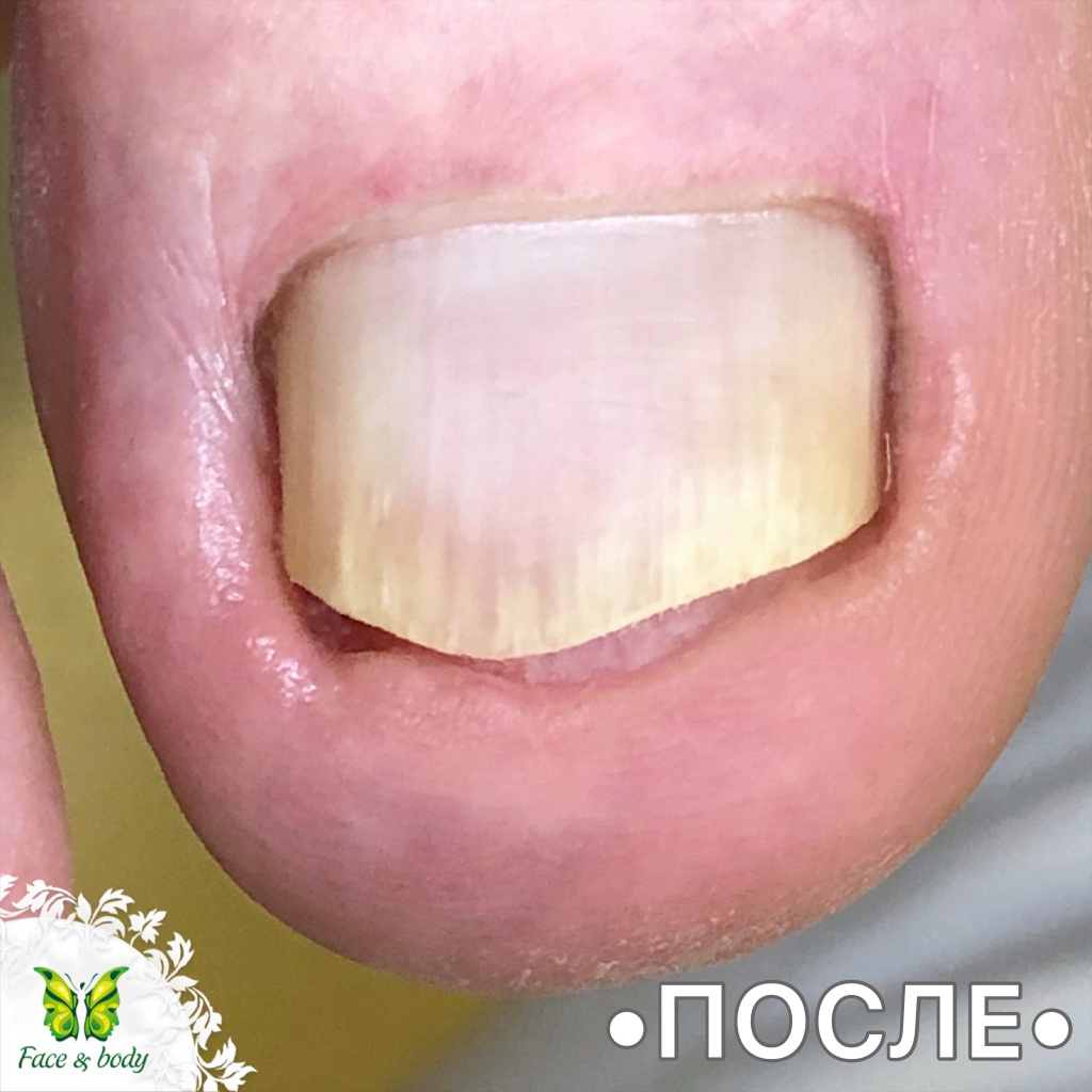 вросш.ног, скоба подофикс (1).JPG